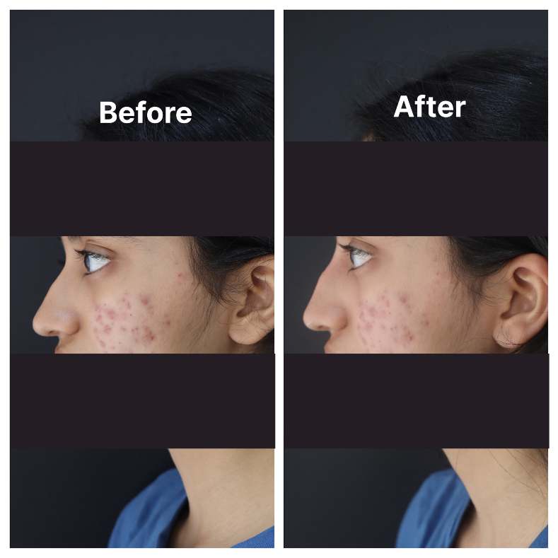 Fillers result KOQ10